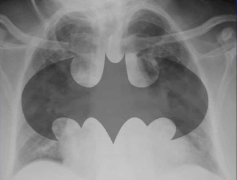 CHF Radiography—From Cardiomegaly to Batwings
