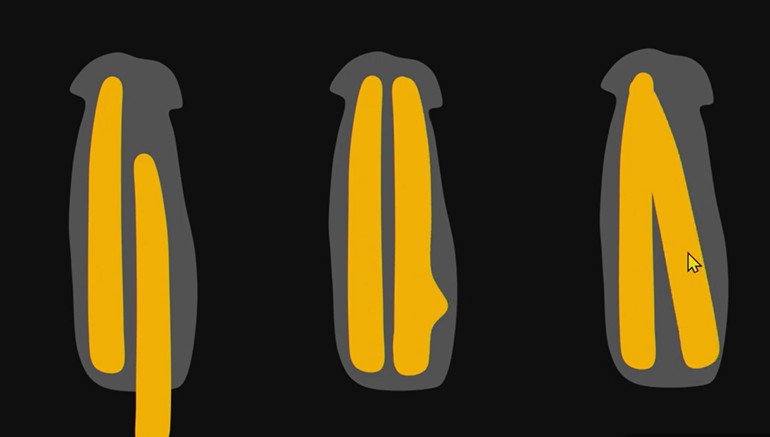 Imaging Penile Prosthesis Complications