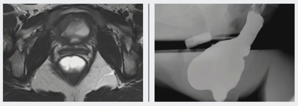 MR vs. Fluoro Defecography in Pelvic Floor Imaging