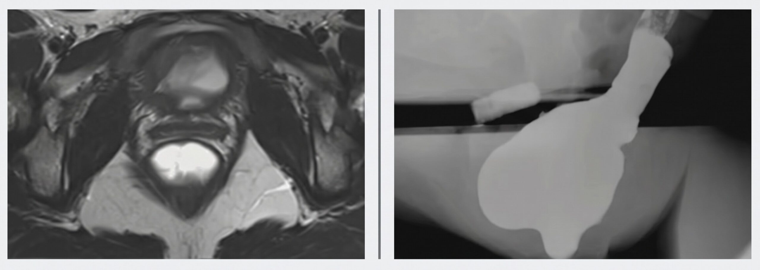 MR vs. Fluoro Defecography in Pelvic Floor Imaging