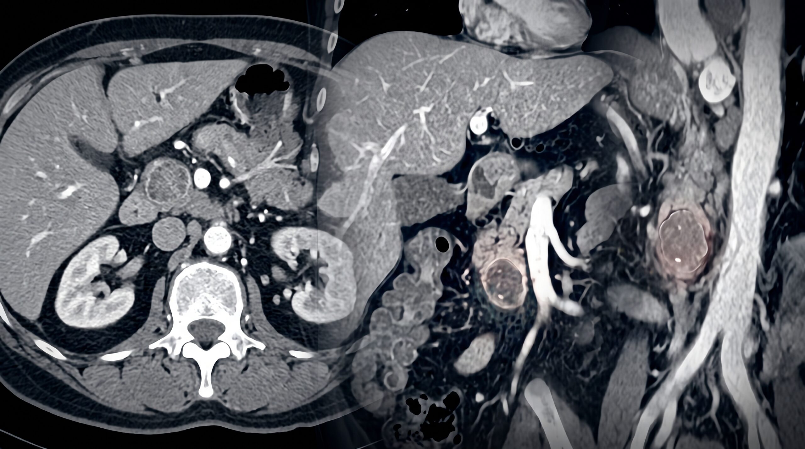 Pancreatic Neuroendocrine Tumor Imaging