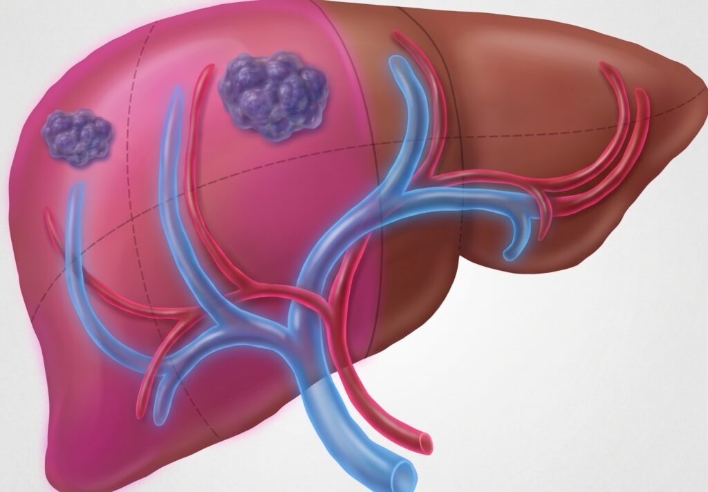Liver Augmentation: Techniques & Trade-Offs