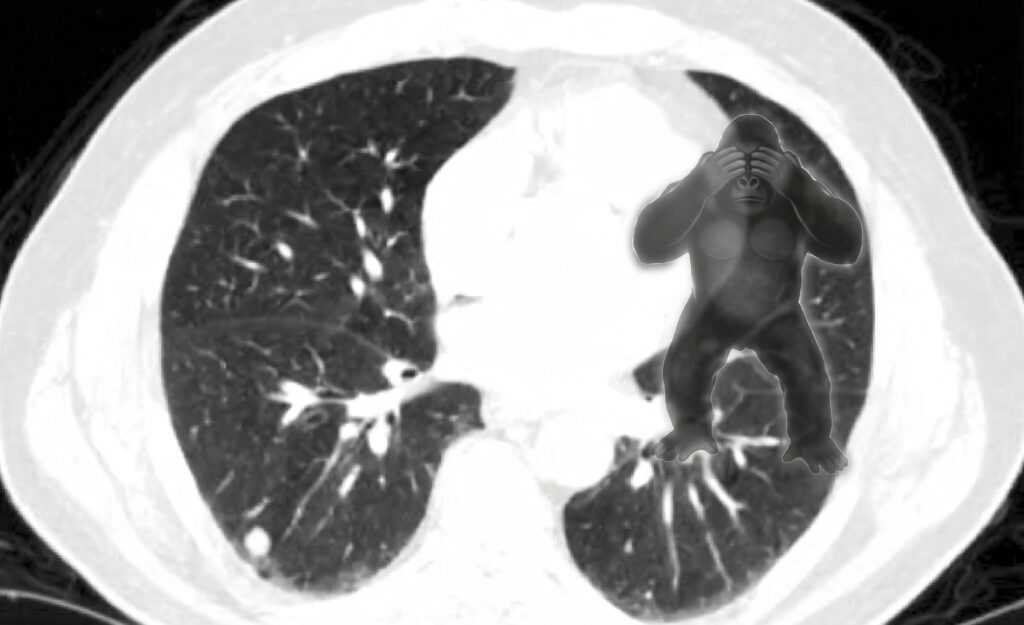 Radiological Blind Spots: Why We Miss the Gorilla